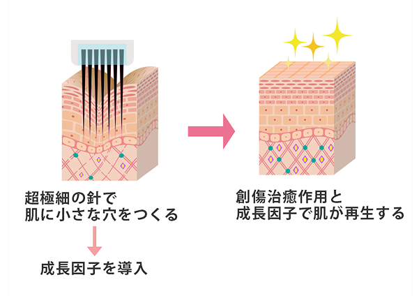 ボルニューマ