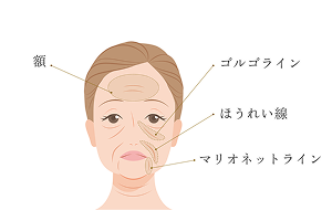 ボトックスに局所麻酔と緩衝材を混ぜている