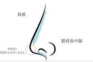 ボトックスに局所麻酔と緩衝材を混ぜている