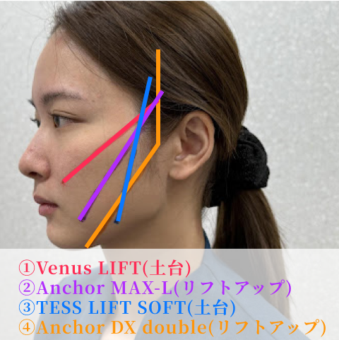 長持ちする設計とデザイン（Dr.永峯オリジナル固定法）