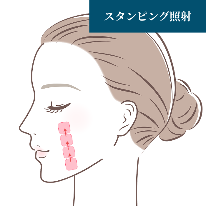 スタンピング照射