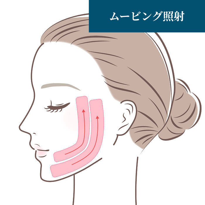 ムービング照射