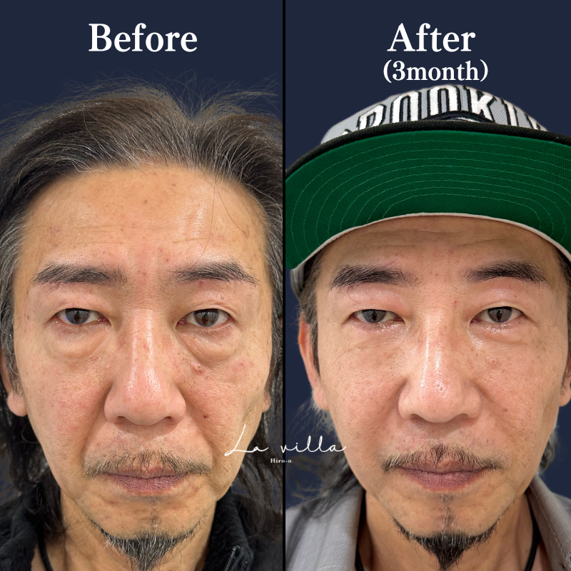 表ハムラ