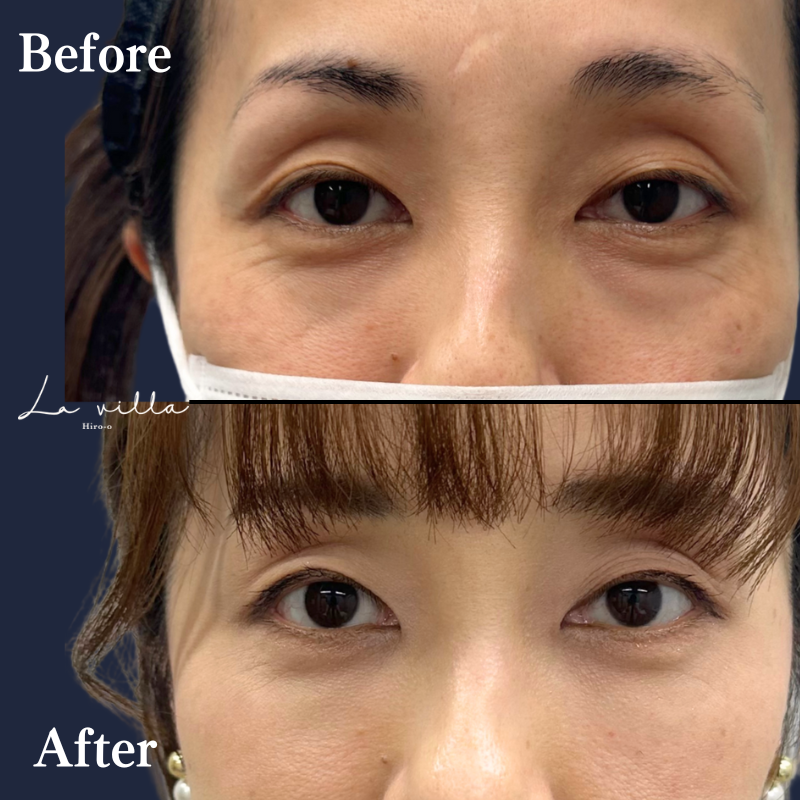 40代　裏ハムラ　No.53