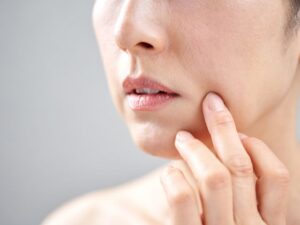 糸リフトでほうれい線改善｜効果と持続のリアル解説