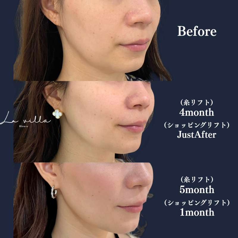 糸リフト+ショッピングリフト No.93