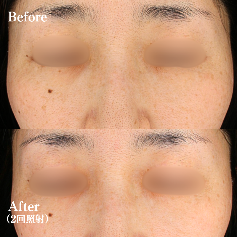 ルビーフラクショナル　No.168