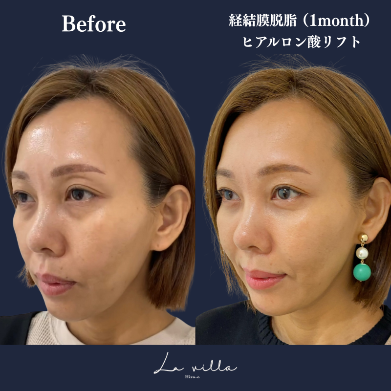 経結膜脱脂+ヒアルロン酸リフト No.134