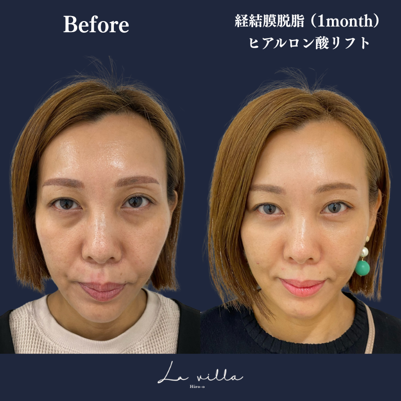 経結膜脱脂+ヒアルロン酸リフト No.134