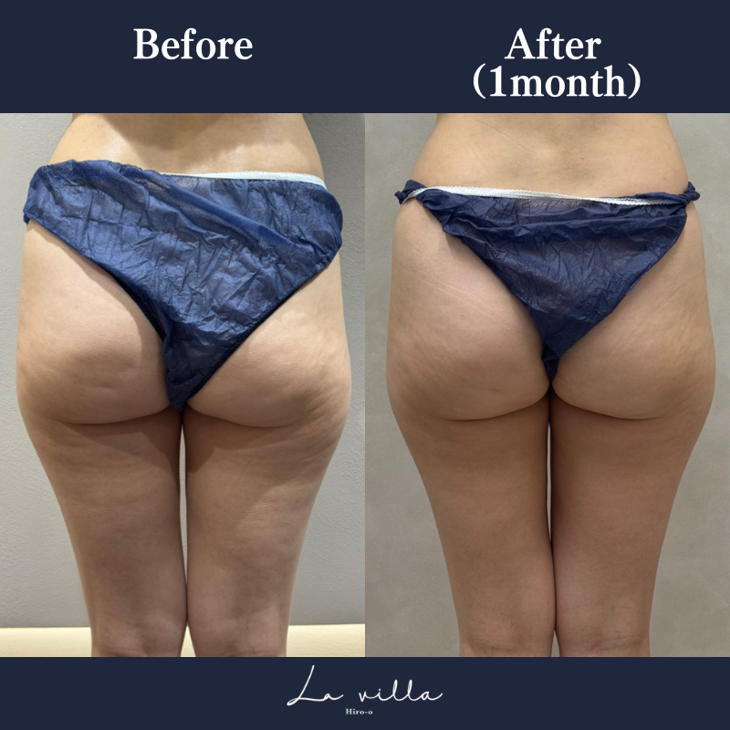 リヴァイブ(ヒップ)No.122