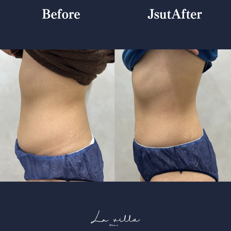 リヴァイブ(お腹)No.123