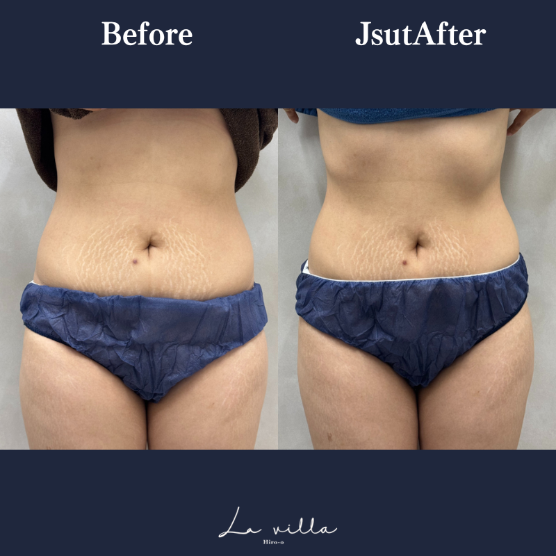 リヴァイブ(お腹)No.123