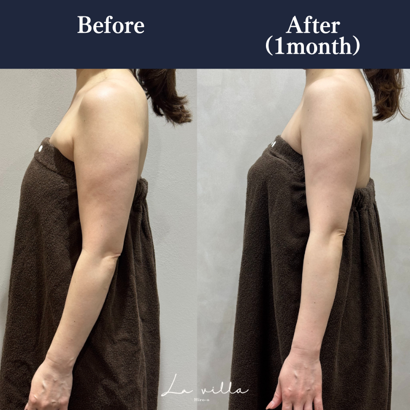 リヴァイブ（腕） No.124