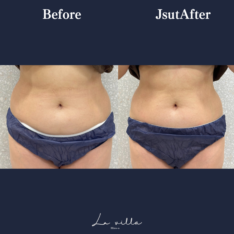 リヴァイブ（お腹） No.125