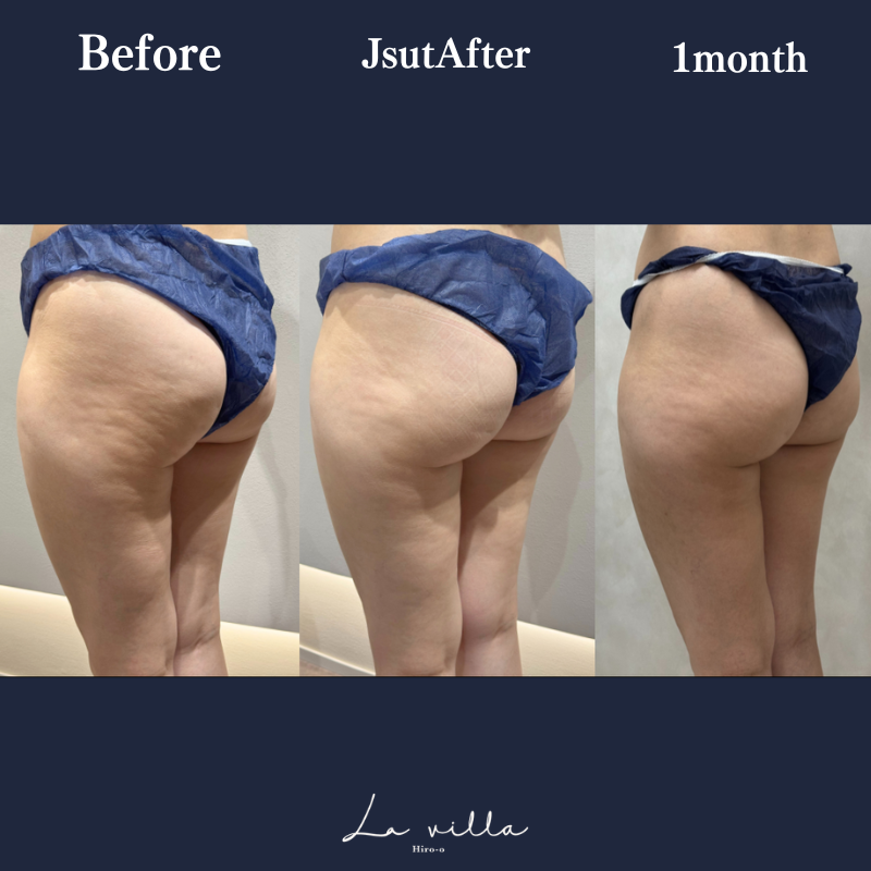 リヴァイブ(ヒップ)No.122