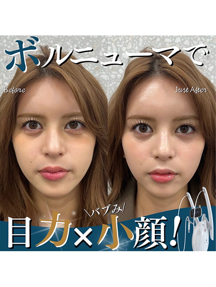 ボルニューマで目力×小顔