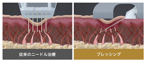 極細ニードル × 高周波エネルギー