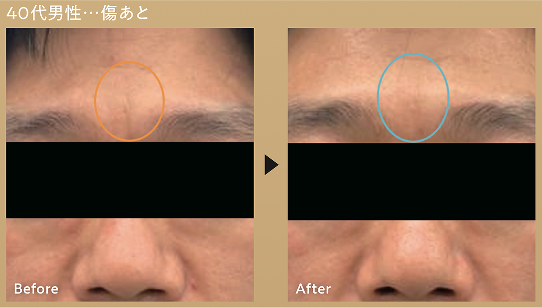 CASE 02 40代男性 傷あと