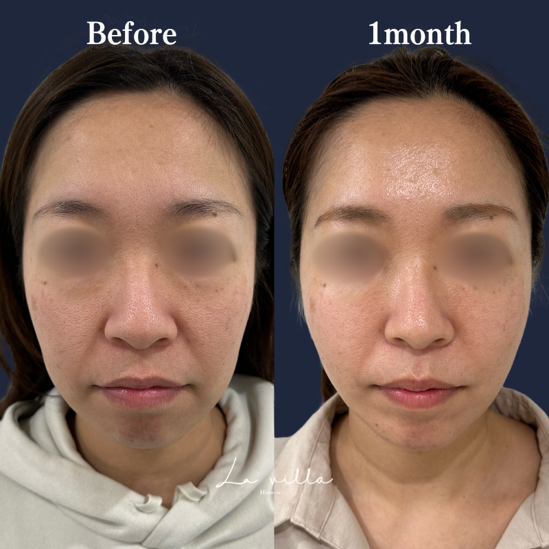 糸リフト+ショッピングリフト No.201