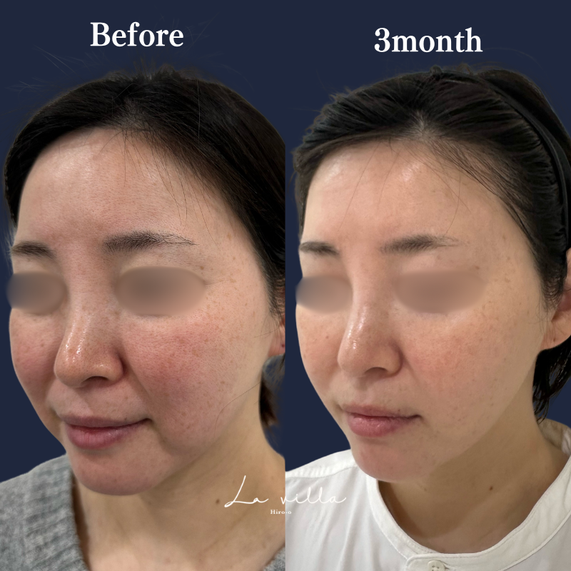 糸リフト+ショッピングリフト+頬の脂肪吸引 No.199