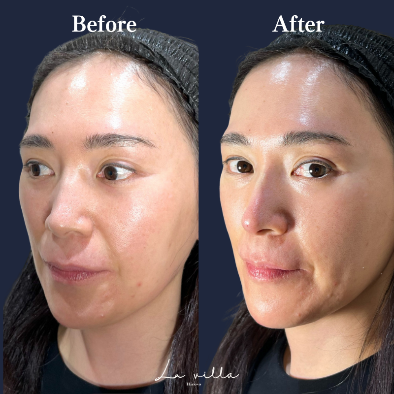 鼻ヒアルロン酸 No.154