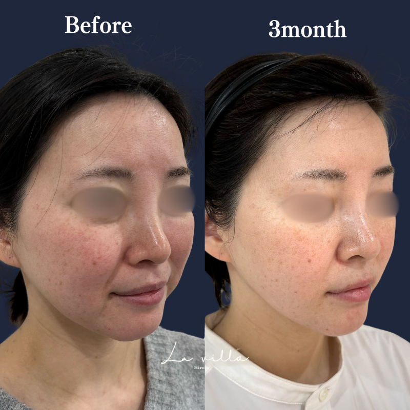 糸リフト+ショッピングリフト+頬の脂肪吸引 No.199