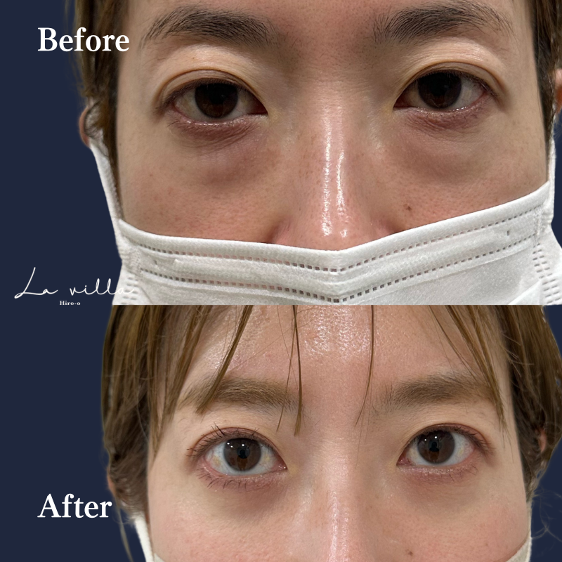 経結膜脱脂　No.204