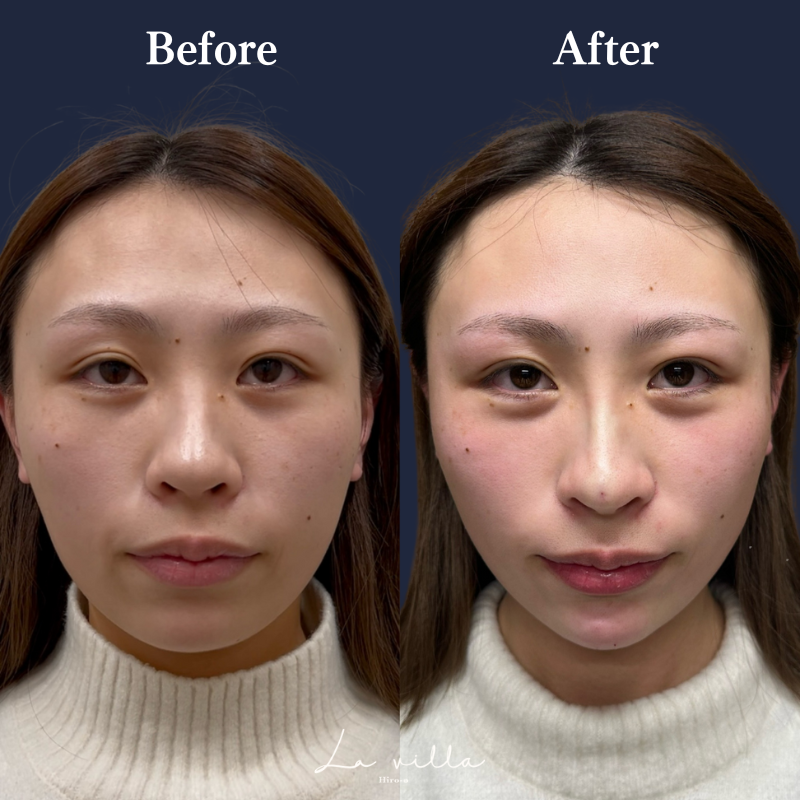 鼻ヒアルロン酸 No.155