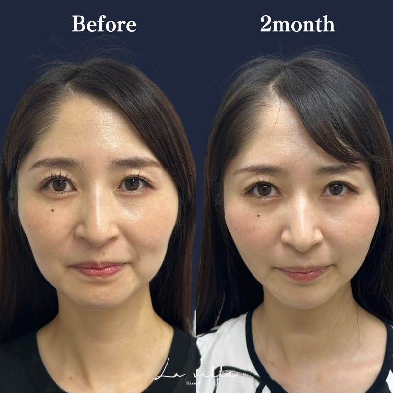 糸リフト　No.148