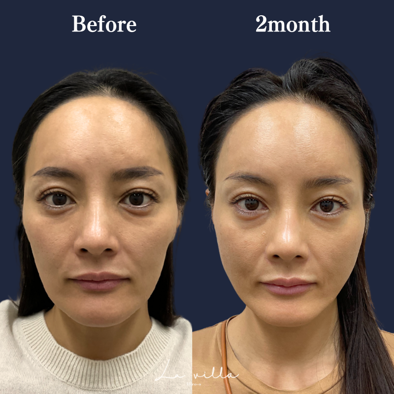 糸リフト+ショッピングリフト No.219