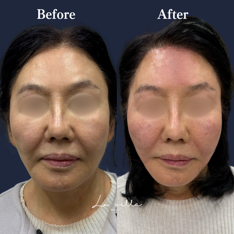 ボルニューマ×リヴァイブ＋糸リフト＋ ショッピングリフト No.220