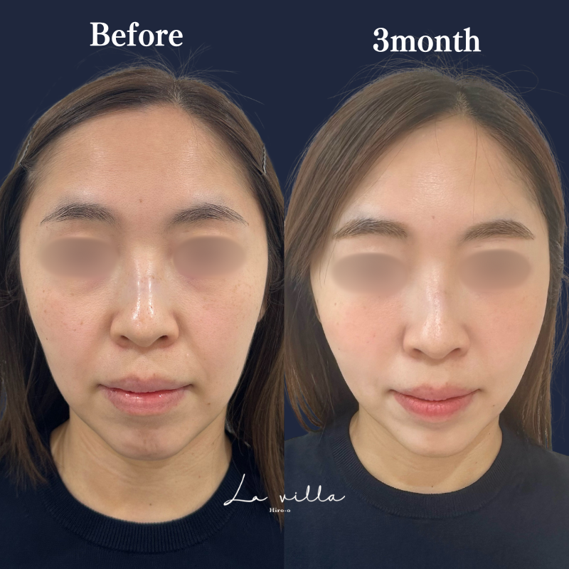 糸リフト+ショッピングリフト No.200