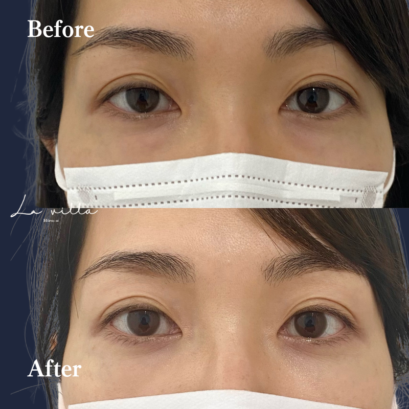 経結膜脱脂+脂肪注入 　No.205