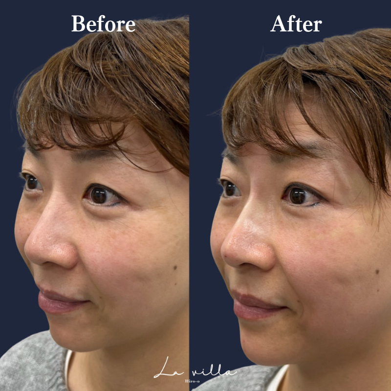 鼻ヒアルロン酸 No.156