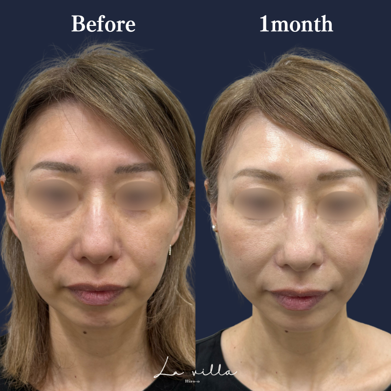 糸リフト+ショッピングリフト No.206