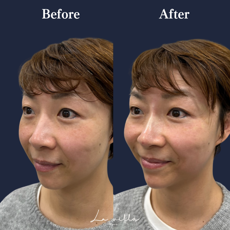 鼻ヒアルロン酸 No.156