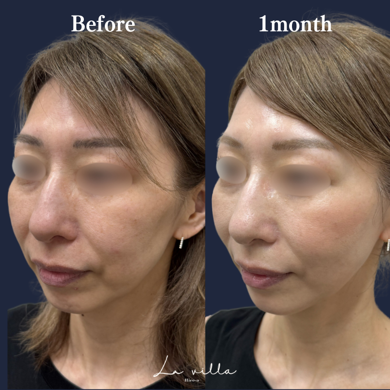 糸リフト+ショッピングリフト No.206