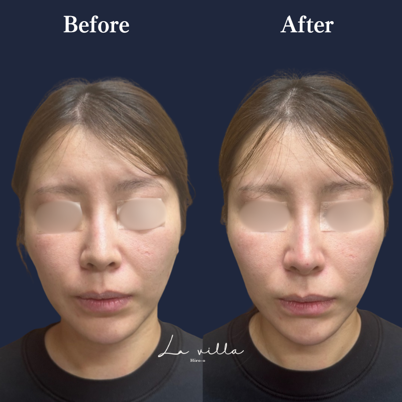 鼻ヒアルロン酸 No.157