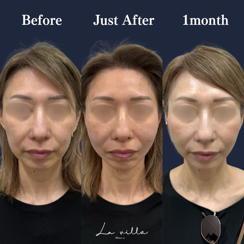 糸リフト+ショッピングリフト No.206