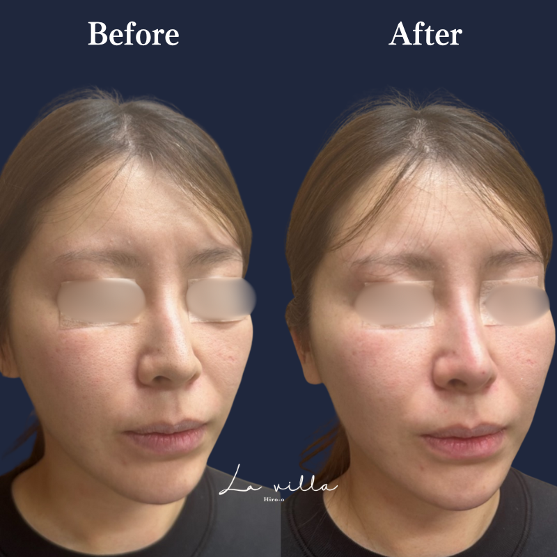 鼻ヒアルロン酸 No.157