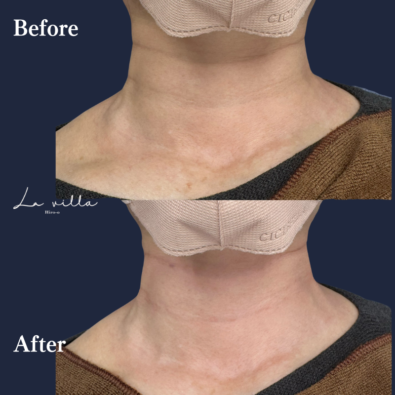 首のボライト No.207