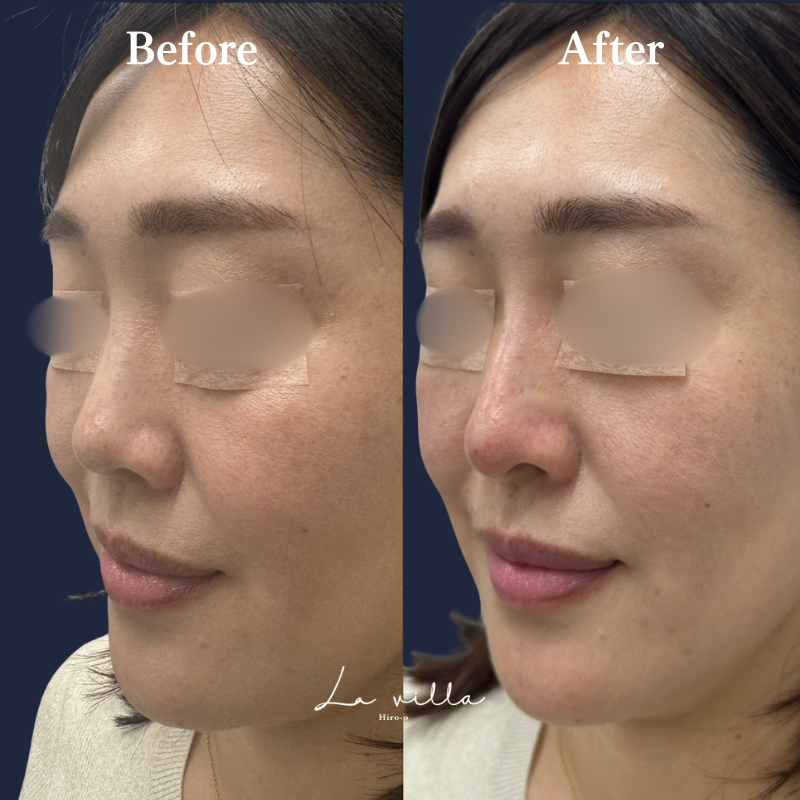 鼻ヒアルロン酸 No.158