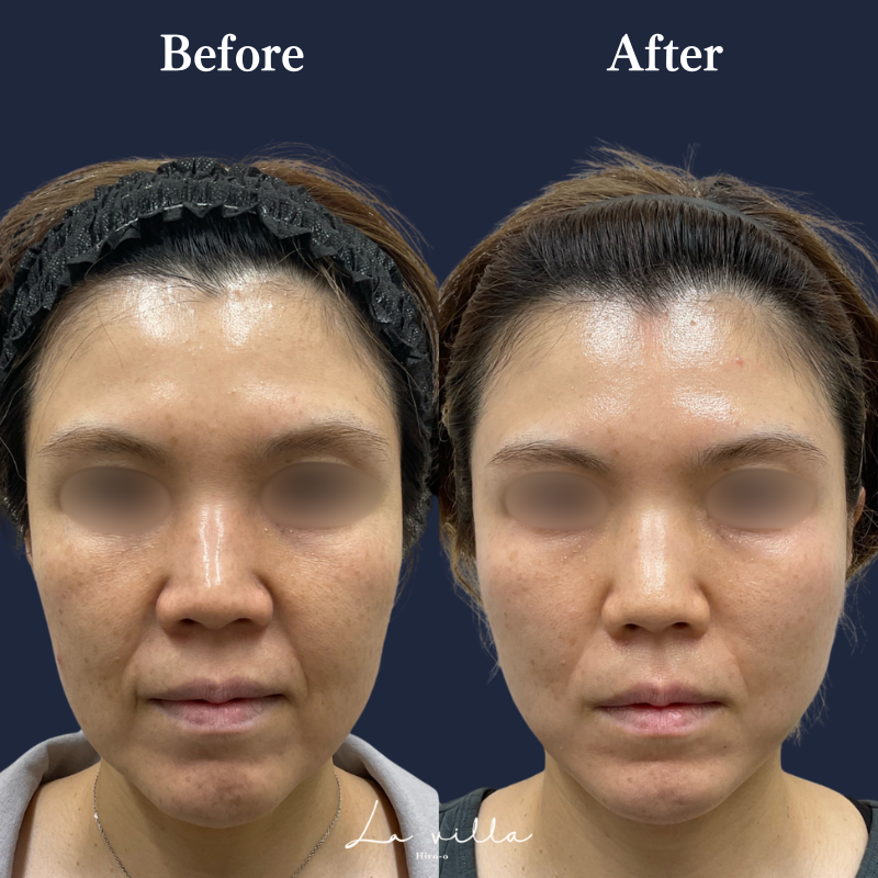 糸リフト+ショッピングリフト No.208