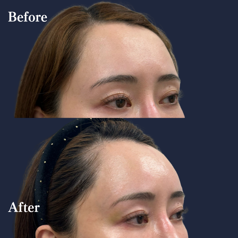 額ヒアルロン酸 No.159