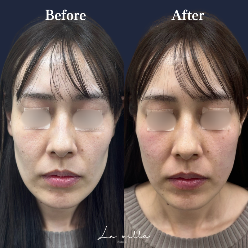 頬ヒアルロン酸 No.160