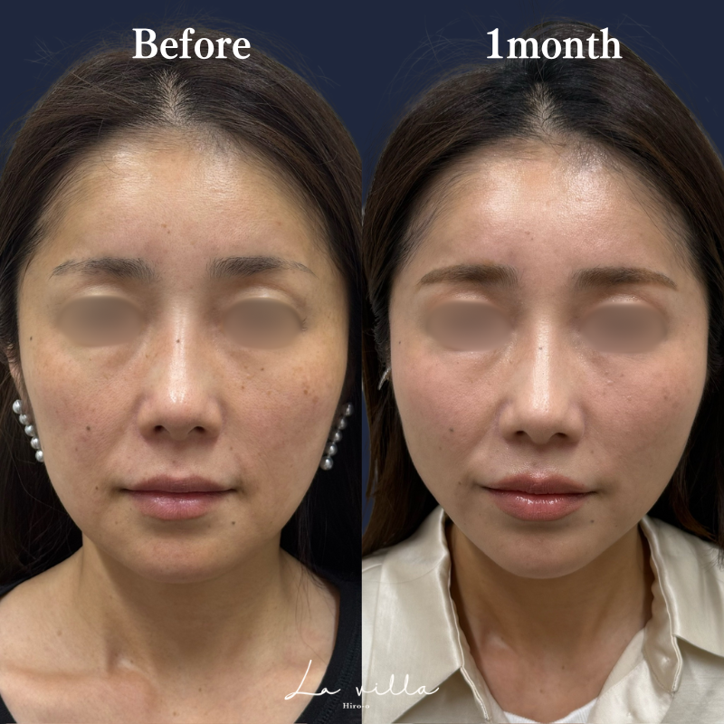 糸リフト+ショッピングリフト No.209