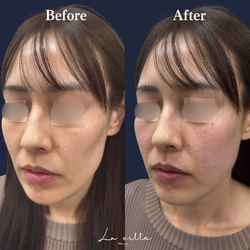 頬ヒアルロン酸 No.160