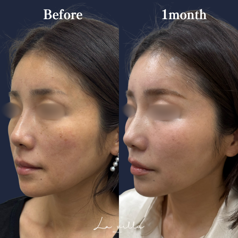 糸リフト+ショッピングリフト No.209