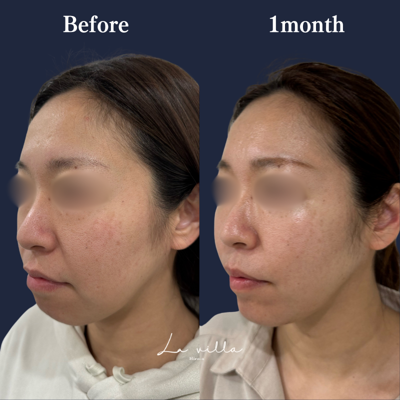 糸リフト+ショッピングリフト No.201