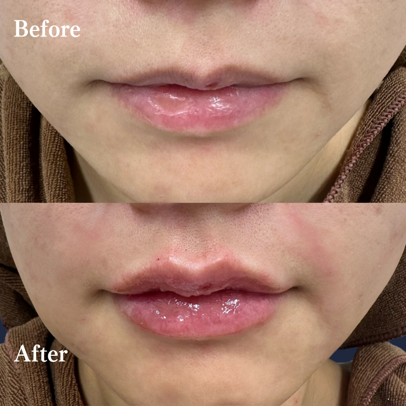 唇ヒアルロン酸  No.151